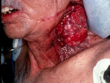 oral-cancer-neck-tumor