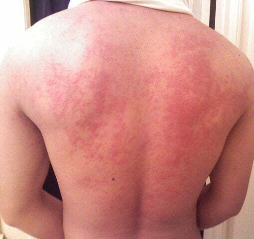 Hives_on_back